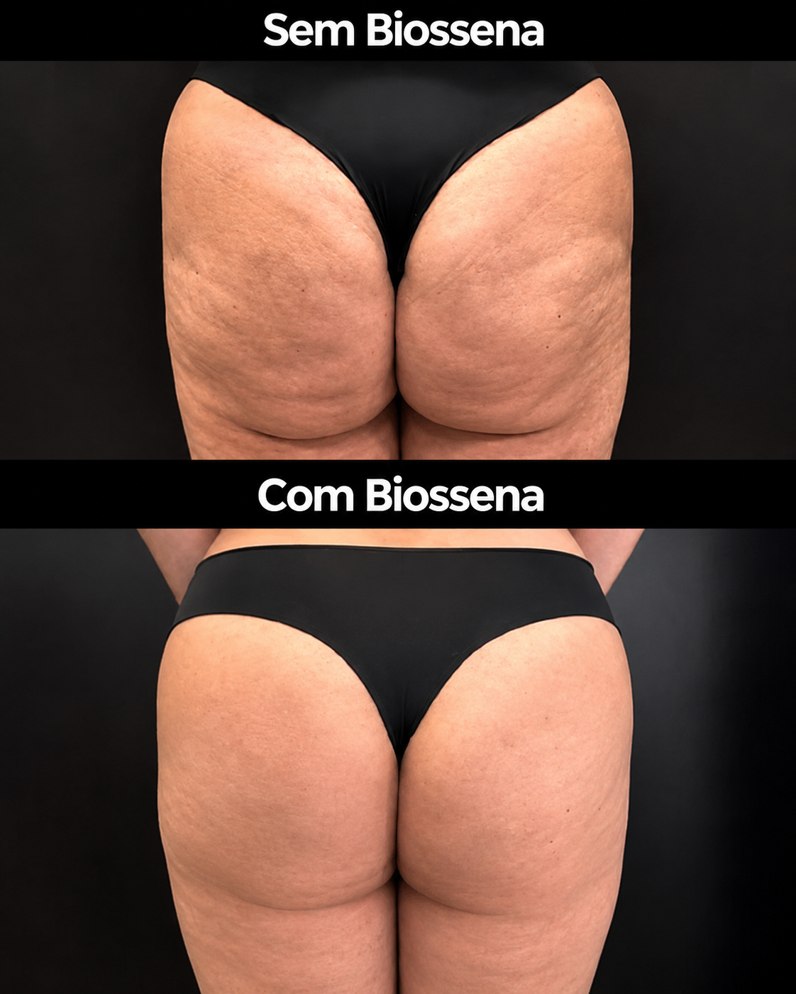 Resultado de antes e depois na celulite